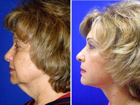 Cosmetic Surgery Facelifts | Cosmetic surgery, Plastic surgery, Facelift