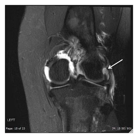 Mri Of Left Knee Showing Popliteofibular Ligament Tear And Edema In