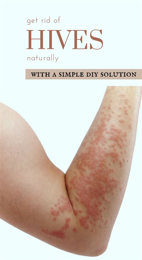 Get Rid Of Hives Naturally With A Simple Diy Solution Beauty Area