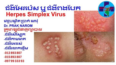 Herpes simplex viruses are worldwide in distribution, equally between the sexes, and without seasonal variation. ជំងឺអែរប៉េស ឬ ជំងឺពងបែក - Herpes Simplex Virus - YouTube