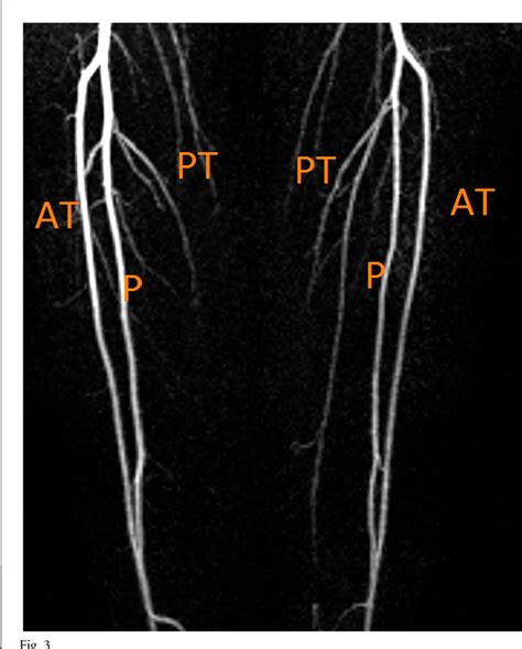Figure From Posterior Tibial Arterial System Deficiency Mimicking