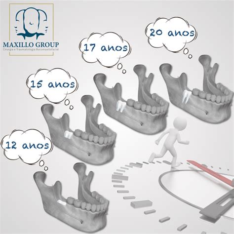 Quanto Tempo Demora Para O Siso Nascer Completamente Maxillo Group