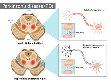 Parkinsons Disease Normal And Depreciated Substantia Nigra