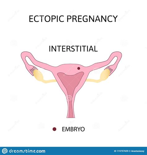 Ectopic Pregnancy Types Of Extra Uterine Pregnancy Is Interstitial