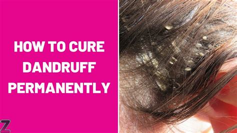 How To Cure Dandruff Permanently Best Dandruff Treatments Youtube