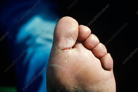 Athletes Foot Stock Image C0031290 Science Photo Library