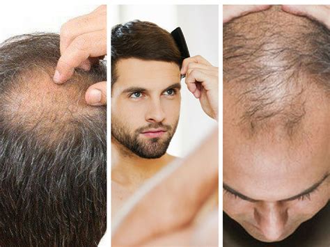 Lelaki paling ramai berhadapan dengan masalah keguguran rambut dan kebotakan. Dah Mula Botak Sebab Rambut Gugur? Ini Tip Mudah Yang Anda ...