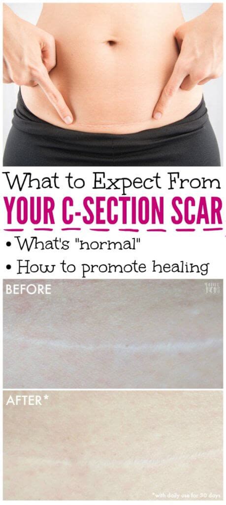 Your C Section Scar 5 Things You Need To Know The Soccer Mom Blog