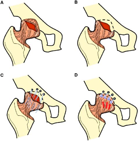 Procedure Illustration Of Capsular Repair Using Proximal Advancement