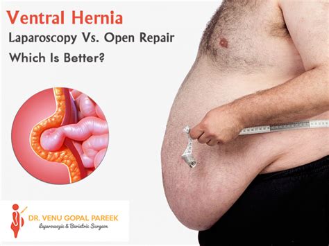 Ventral Hernia Laparoscopy Vs Open Repair Which Is Better