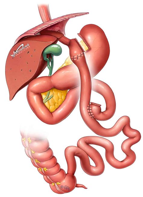 Gastric Bypass Surgery Sydney Stomach Bypass Weight Loss Surgery