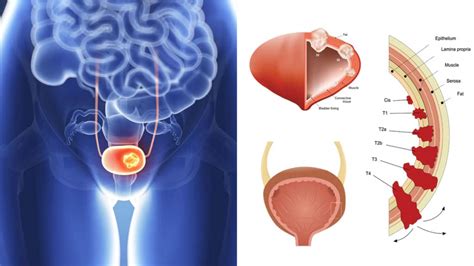 What Are The Symptoms Of Bladder Cancer In A Female Drains Bladder