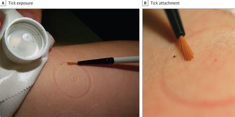 Cutaneous Lesions Due To Bites By Larval Amblyomma Americanum Ticks