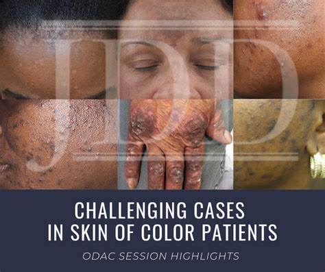 Challenging Cases In Skin Of Color Patients Next Steps In Dermatology