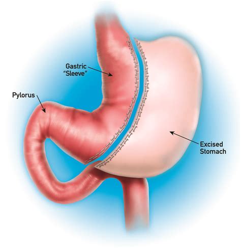 Sleeve Gastrectomy In Plano Dallas Laparoscopic Gastric Sleeve Surgery Dr Malladi