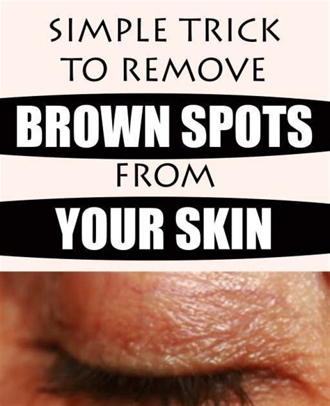 Simple Trick To Remove Brown Spots From Your Skin Wellness Days