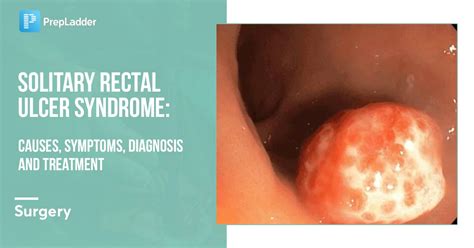 Solitary Rectal Ulcer Syndrome Causes Symptoms Diagnosis And Treatment