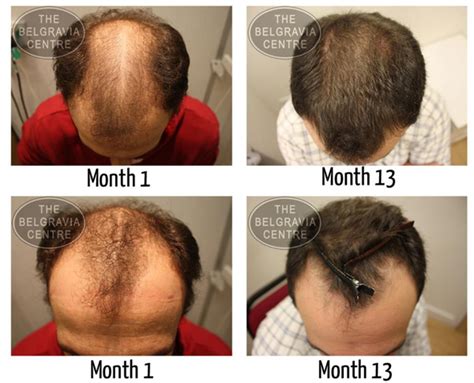 Is It True You Can Lose Your Hair After A Hair Transplant