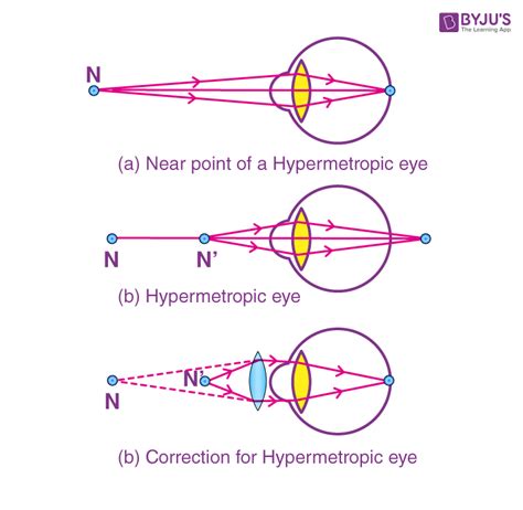 defects of vision and their correction myopia hypermetropia presbyopia and faqs