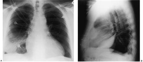 Computed tomography scan of the chest demonstrates loculated pleural effusion in the left major fissure (arrow) in a patient after coronary bypass. Disease of the Pleura | Radiology Key