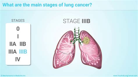 Stage iv is the most advanced form. Staging of Lung Cancer - YouTube
