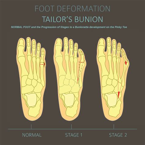 Developmental Disorders Of The Foot And Ankle Springerlink Toe