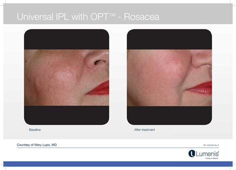 Rosacea Treatments With Ipl Igbeauty Skin Clinic Toronto