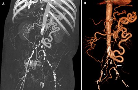 Ct Angiography And 3d Imaging In Aortoiliac Occlusive Disease