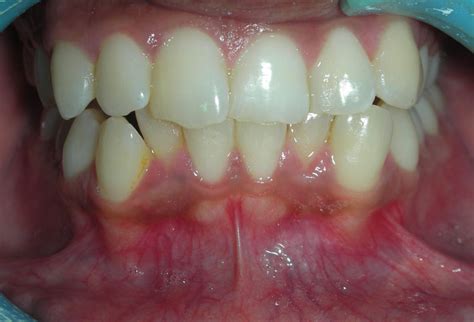 Treated Cases Frenectomy Restore Dental Treatment Centre Rajkot