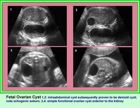 ovarian cysts department of obstetrics and gynecology faculty of medicine chiang mai university