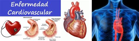 Todas Las Enfermedades Cardiovasculares Diez Para Evitar Problemas