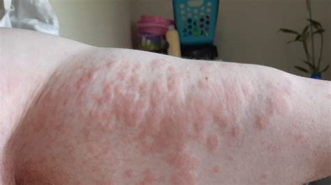 Lara Rash Residents Developing ‘hive Like Skin Irritation Geelong