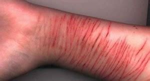 About 1 in 100 people experience this. Self Harm Deep Cuts Quotes. QuotesGram
