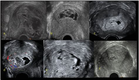Figure From Ultrasound Diagnosis Of Molar Pregnancy Semantic Scholar