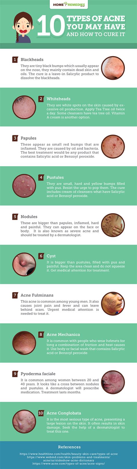 10 Types Of Acne You May Haveand How To Cure It Infographic