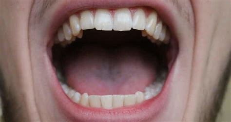 Jun 30, 2014 · a simple release exercise to start with is to sit quietly with mouth slightly open, tip of tongue very gently touching behind front teeth or roof of mouth and just let the jaw hang and relax for. Bump Or Lump On The Roof Of Mouth: Causes,Treatment,Home Remedies