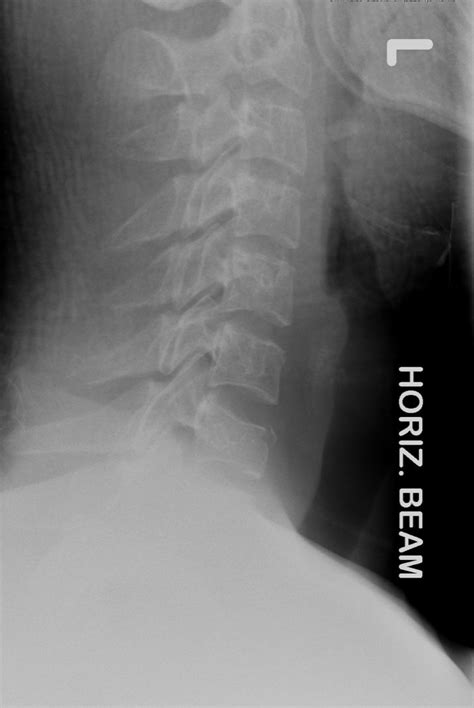 Cervical Fractures Emergent Stabilization And Treatment Congenital