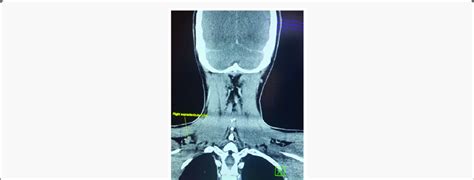 Ct Scan Of The Neck Yellow Arrow Showing Right Supraclavicular Lns