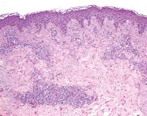 Polymorphic Eruption Of Pregnancy Skin Biopsy Showing Moderate