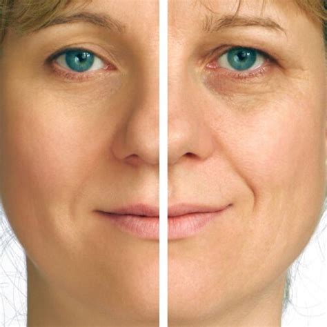 Correct A Chronic Tired Look With A Facelift Blog Marottamd