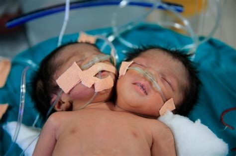 The Yellow Party News Conjoined Twins Born In India With 2 Heads 1 Body