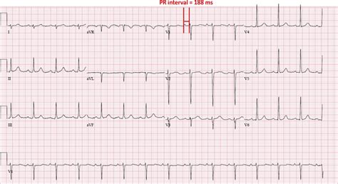 Standard 12 Lead Electrocardiogram Showing Normal Sinus Rhythm And Pr