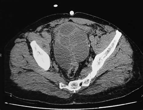 Ct Scan Showing Pelvic Multilocular Heterogeneous Cystic Mass With Many Hot Sex Picture