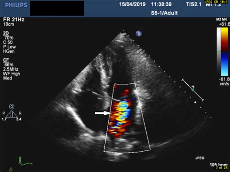 Atypical Marantic Endocarditis Bmj Case Reports