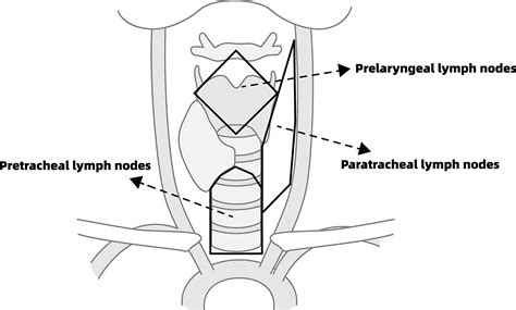 Pretracheallaryngeal Lymph Nodes In Frozen Section Predicting