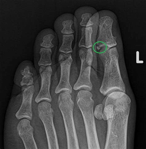 Management Of Toe Fractures Sports Medicine Review