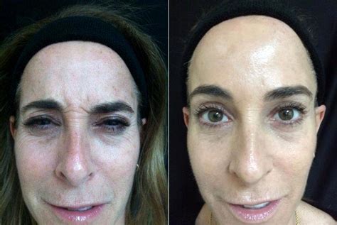 Female Treated With Botox 11 Lines In Forehead And Crows Feet Before