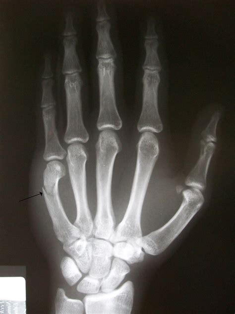 File Boxers Fracture Wikimedia Commons