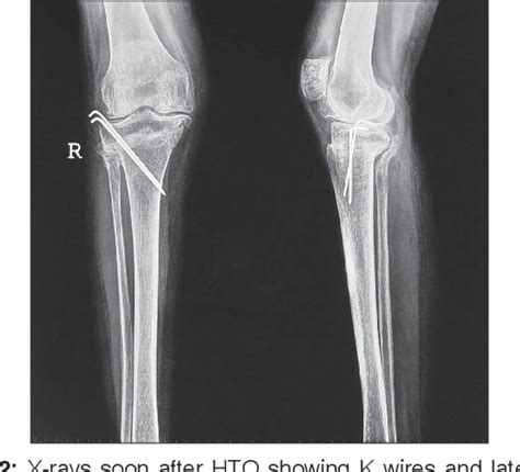 Figure 2 From High Tibial Closing Wedge Osteotomy For Medial