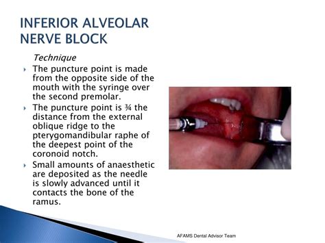 Inferior Alveolar Block Technique